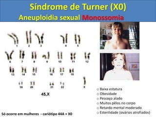 o Baixa estatura
o Obesidade
o Pescoço alado
o Muitos pêlos no corpo
o Retardo mental moderado
o Esterilidade (ovários atrofiados)
Síndrome de Turner (X0)
Só ocorre em mulheres - cariótipo 44A + X0
Aneuploidia sexual Monossomia
 