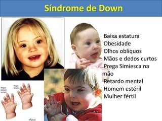 Baixa estatura
Obesidade
Olhos oblíquos
Mãos e dedos curtos
Prega Simiesca na
mão
Retardo mental
Homem estéril
Mulher fértil
Síndrome de Down
 
