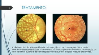 TRATAMENTO
A - Retinopatia diabética proliferativa fotocoagulada com laser argônio. Marcas de
laser recentemente aplicadas. B - Resultado da fotocoagulação mostrando cicatrização do
laser na retina, ausência de hemorragias ou de exsudatos e região macular preservada.
7/21/2014por Anielly Meira de Lacerda Macêdo
15
 