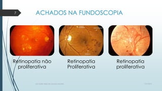 ACHADOS NA FUNDOSCOPIA
Retinopatia não
proliferativa
Retinopatia
Proliferativa
Retinopatia
proliferativa
7/21/2014por Anielly Meira de Lacerda Macêdo
7
 