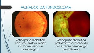 ACHADOS DA FUNDOSCOPIA
Retinopatia diabética
não proliferativa inicial;
microaneurismas e
hemorragias.
Retinopatia diabética
proliferativa complicada
por extensa hemorragia
pré-retiniana. 7/21/2014por Anielly Meira de Lacerda Macêdo
8
 