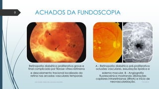 ACHADOS DA FUNDOSCOPIA
Retinopatia diabética proliferativa grave e
final complicada por fibrose vítreo-retiniana
e descolamento tracional localizado da
retina nas arcadas vasculares temporais
A - Retinopatia diabética pré-proliferativa:
oclusões vasculares, exsudação lipídica e
edema macular. B - Angiografia
fluoresceínica mostrando dilatações
capilares intraretinianas (IRMA) e início de
neovascularização. 7/21/2014por Anielly Meira de Lacerda Macêdo
9
 