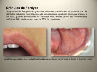 Grânulos de Fordyce
Os grânulos de Fordyce são glândulas sebáceas que ocorrem na mucosa oral. As
glândulas sebáceas normalmente são consideradas estruturas dérmicas anexas, e
por isso, quando encontradas na cavidade oral, muitas vezes são consideradas
ectópicas. São relatados em mais de 80% da população.
Múltiplas pápulas amareladas localizadas na região de semimucosa labial e mucosa jugal.
 