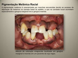 Pigmentação Melânica Racial
A pigmentação melânica é caracterizada por manchas escurecidas devido ao excesso de
deposição de melanina na camada basal do epitélio, e que na cavidade bucal acometem
especialmente a gengiva marginal livre e gengiva inserida.
Mácula de coloração enegrecida localizada em gengiva
marginal e inserida em um paciente da raça negra.
 