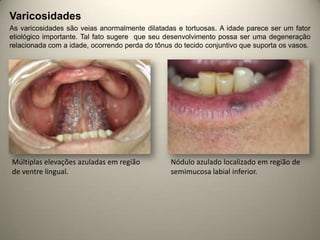 Varicosidades
As varicosidades são veias anormalmente dilatadas e tortuosas. A idade parece ser um fator
etiológico importante. Tal fato sugere que seu desenvolvimento possa ser uma degeneração
relacionada com a idade, ocorrendo perda do tônus do tecido conjuntivo que suporta os vasos.
Múltiplas elevações azuladas em região
de ventre lingual.
Nódulo azulado localizado em região de
semimucosa labial inferior.
 