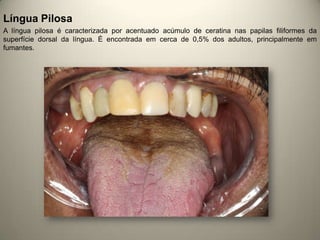 Língua Pilosa
A língua pilosa é caracterizada por acentuado acúmulo de ceratina nas papilas filiformes da
superfície dorsal da língua. É encontrada em cerca de 0,5% dos adultos, principalmente em
fumantes.
 