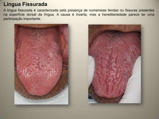 Língua Fissurada
A língua fissurada é caracterizada pela presença de numerosas fendas ou fissuras presentes
na superfície dorsal da língua. A causa é incerta, mas a hereditariedade parece ter uma
participação importante.
 