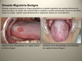Glossite Migratória Benigna
Glossite migratória benigna ou língua geográfica é a atrofia migratória das papilas filiformes do
dorso da língua. As lesões não comprometem o paladar e podem permanecer ativas por períodos
curtos ou longos, regredir espontaneamente e reaparecer depois em local diferente.
Pequena área despapilada em região lateral
do dorso lingual.
Múltiplas áreas despapiladas avermelhadas
em região de dorso lingual.
 