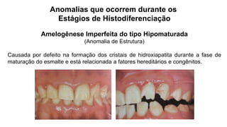 Anomalias que ocorrem durante os
Estágios de Histodiferenciação
Amelogênese Imperfeita do tipo Hipomaturada
(Anomalia de Estrutura)
Causada por defeito na formação dos cristais de hidroxiapatita durante a fase de
maturação do esmalte e está relacionada a fatores hereditários e congênitos.
 