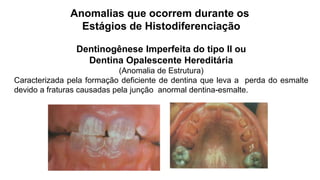 Anomalias que ocorrem durante os
Estágios de Histodiferenciação
Dentinogênese Imperfeita do tipo II ou
Dentina Opalescente Hereditária
(Anomalia de Estrutura)
Caracterizada pela formação deficiente de dentina que leva a perda do esmalte
devido a fraturas causadas pela junção anormal dentina-esmalte.
 