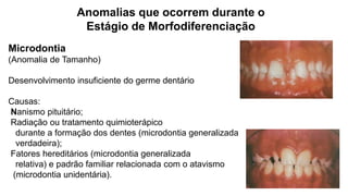 Anomalias que ocorrem durante o
Estágio de Morfodiferenciação
Microdontia
(Anomalia de Tamanho)
Desenvolvimento insuficiente do germe dentário
Causas:
Nanismo pituitário;
Radiação ou tratamento quimioterápico
durante a formação dos dentes (microdontia generalizada
verdadeira);
Fatores hereditários (microdontia generalizada
relativa) e padrão familiar relacionada com o atavismo
(microdontia unidentária).
 