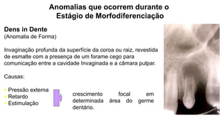 Dens in Dente
(Anomalia de Forma)
Invaginação profunda da superfície da coroa ou raiz, revestida
de esmalte com a presença de um forame cego para
comunicação entre a cavidade Invaginada e a câmara pulpar.
Causas:
 Pressão externa
 Retardo
 Estimulação
Anomalias que ocorrem durante o
Estágio de Morfodiferenciação
crescimento focal em
determinada área do germe
dentário.
 