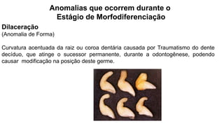 Anomalias que ocorrem durante o
Estágio de Morfodiferenciação
Dilaceração
(Anomalia de Forma)
Curvatura acentuada da raiz ou coroa dentária causada por Traumatismo do dente
decíduo, que atinge o sucessor permanente, durante a odontogênese, podendo
causar modificação na posição deste germe.
 