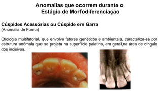 Anomalias que ocorrem durante o
Estágio de Morfodiferenciação
Cúspides Acessórias ou Cúspide em Garra
(Anomalia de Forma)
Etiologia multifatorial, que envolve fatores genéticos e ambientais, caracteriza-se por
estrutura anômala que se projeta na superfície palatina, em geral,na área de cíngulo
dos incisivos.
 