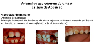 Anomalias que ocorrem durante o
Estágio de Aposição
Hipoplasia de Esmalte
(Anomalia de Estrutura)
Formação incompleta ou defeituosa da matriz orgânica do esmalte causada por fatores
ambientais de natureza sistêmica (febre) ou local (traumatismo).
 