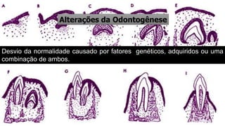 Alterações da Odontogênese
Desvio da normalidade causado por fatores genéticos, adquiridos ou uma
combinação de ambos.
 