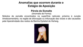 Anomalias que ocorrem durante o
Estágio de Aposição
Pérola do Esmalte
(Anomalia de Forma)
Nódulos de esmalte encontrados na superfície radicular, próximo à Junção
Amelocementária, na região de bifurcação ou trifurcação das raízes e são causadas
pela hiperatividade dos restos da Bainha Epitelial de Hertwig.
 