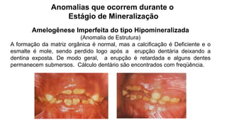 Anomalias que ocorrem durante o
Estágio de Mineralização
Amelogênese Imperfeita do tipo Hipomineralizada
(Anomalia de Estrutura)
A formação da matriz orgânica é normal, mas a calcificação é Deficiente e o
esmalte é mole, sendo perdido logo após a erupção dentária deixando a
dentina exposta. De modo geral, a erupção é retardada e alguns dentes
permanecem submersos. Cálculo dentário são encontrados com freqüência.
 
