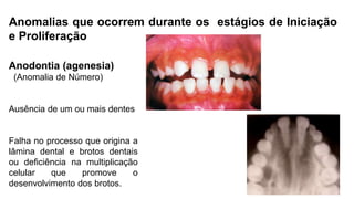 Anomalias que ocorrem durante os estágios de Iniciação
e Proliferação
Anodontia (agenesia)
(Anomalia de Número)
Ausência de um ou mais dentes
Falha no processo que origina a
lâmina dental e brotos dentais
ou deficiência na multiplicação
celular que promove o
desenvolvimento dos brotos.
 