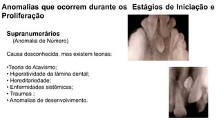 Anomalias que ocorrem durante os Estágios de Iniciação e
Proliferação
Supranumerários
(Anomalia de Número)
Causa desconhecida, mas existem teorias:
•Teoria do Atavismo;
• Hiperatividade da lâmina dental;
• Hereditariedade;
• Enfermidades sistêmicas;
• Traumas ;
• Anomalias de desenvolvimento.
 