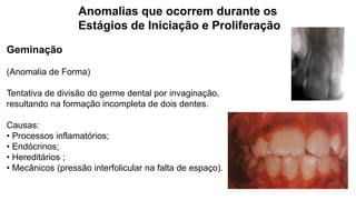Anomalias que ocorrem durante os
Estágios de Iniciação e Proliferação
Geminação
(Anomalia de Forma)
Tentativa de divisão do germe dental por invaginação,
resultando na formação incompleta de dois dentes.
Causas:
• Processos inflamatórios;
• Endócrinos;
• Hereditários ;
• Mecânicos (pressão interfolicular na falta de espaço).
 