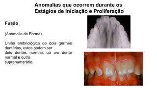 Anomalias que ocorrem durante os
Estágios de Iniciação e Proliferação
Fusão
(Anomalia de Forma)
União embriológica de dois germes
dentários, estes podem ser
dois dentes normais ou um dente
normal e outro
supranumerário.
 
