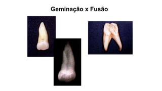 Geminação x Fusão
 