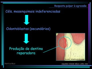 Céls. mesenquimais indeferenciadas
Produção de dentina
reparadora
Resposta pulpar à agressão
Odontoblastos (secundários)
OLGART, BERGENHOLTZ, 2006
Patrícia Ruiz SIQUEIRA JÚNIOR; RÔÇAS; LOPES, 2010
 