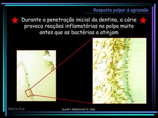 OLGART; BERGENHOLTZ, 2006
Durante a penetração inicial da dentina, a cárie
provoca reações inflamatórias na polpa muito
antes que as bactérias a atinjam
Resposta pulpar à agressão
Patrícia Ruiz
 