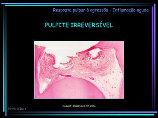 OLGART; BERGENHOLTZ, 2006
Resposta pulpar à agressão – Inflamação aguda
PULPITE IRREVERSÍVEL
Patrícia Ruiz
 