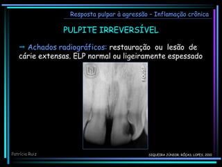PULPITE IRREVERSÍVEL
Resposta pulpar à agressão – Inflamação crônica
 Achados radiográficos: restauração ou lesão de
cárie extensas. ELP normal ou ligeiramente espessado
Patrícia Ruiz SIQUEIRA JÚNIOR; RÔÇAS; LOPES, 2010
 