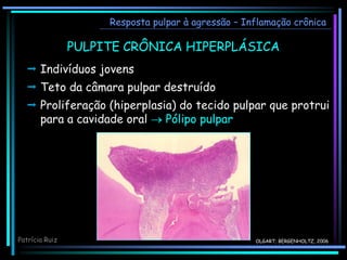  Indivíduos jovens
 Teto da câmara pulpar destruído
 Proliferação (hiperplasia) do tecido pulpar que protrui
para a cavidade oral  Pólipo pulpar
OLGART; BERGENHOLTZ, 2006
Resposta pulpar à agressão – Inflamação crônica
PULPITE CRÔNICA HIPERPLÁSICA
Patrícia Ruiz
 