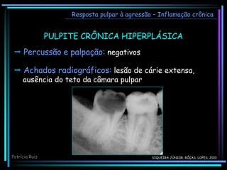 Resposta pulpar à agressão – Inflamação crônica
PULPITE CRÔNICA HIPERPLÁSICA
 Percussão e palpação: negativos
 Achados radiográficos: lesão de cárie extensa,
ausência do teto da câmara pulpar
Patrícia Ruiz SIQUEIRA JÚNIOR; RÔÇAS; LOPES, 2010
 