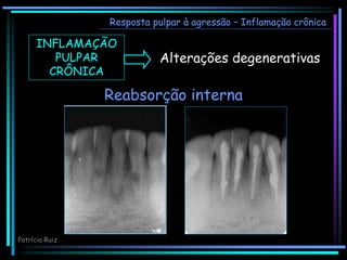 Alterações degenerativas
INFLAMAÇÃO
PULPAR
CRÔNICA
Reabsorção interna
Resposta pulpar à agressão – Inflamação crônica
Patrícia Ruiz
 