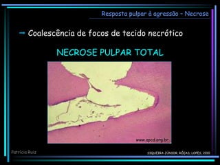  Coalescência de focos de tecido necrótico
Resposta pulpar à agressão – Necrose
www.apcd.org.br
NECROSE PULPAR TOTAL
Patrícia Ruiz SIQUEIRA JÚNIOR; RÔÇAS; LOPES, 2010
 