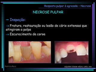 NECROSE PULPAR
 Inspeção:
 Fratura, restauração ou lesão de cárie extensas que
atingiram a polpa
 Escurecimento da coroa
Resposta pulpar à agressão – Necrose
Patrícia Ruiz SIQUEIRA JÚNIOR; RÔÇAS; LOPES, 2010
 