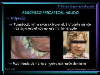  Inspeção:
 Tumefação intra e/ou extra-oral, flutuante ou não
• Estágio inicial não apresenta tumefação
Inflamação periapical aguda
ABSCESSO PERIAPICAL AGUDO
HAPPONEN, BERGENHOLTZ, 2006
HAPPONEN, BERGENHOLTZ, 2006
 Mobilidade dentária e ligeira extrusão dentária
Patrícia Ruiz SIQUEIRA JÚNIOR; RÔÇAS; LOPES, 2010
 