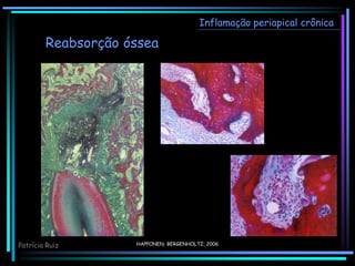HAPPONEN; BERGENHOLTZ, 2006
Inflamação periapical crônica
Reabsorção óssea
Patrícia Ruiz
 