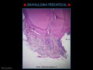 GRANULOMA PERIAPICAL
http://patoral.umayor.cl
Patrícia Ruiz
 