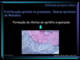 Inflamação periapical crônica
Patrícia Ruiz
Proliferação epitelial no granuloma - Restos epiteliais
de Malassez
Formação de ilhotas de epitélio organizado
HAPPONEN; BERGENHOLTZ, 2006
SIQUEIRA JÚNIOR; RÔÇAS; LOPES, 2010
 
