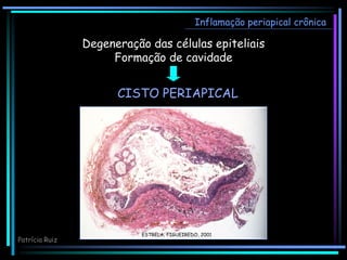 Inflamação periapical crônica
Degeneração das células epiteliais
Formação de cavidade
CISTO PERIAPICAL
ESTRELA; FIGUEIREDO, 2001
Patrícia Ruiz
 