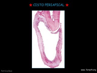 CISTO PERIAPICAL
www. forsyth.org
Patrícia Ruiz
 