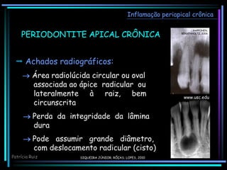 Inflamação periapical crônica
 Achados radiográficos:
 Área radiolúcida circular ou oval
associada ao ápice radicular ou
lateralmente à raiz, bem
circunscrita
 Perda da integridade da lâmina
dura
 Pode assumir grande diâmetro,
com deslocamento radicular (cisto)
HAPPONEN,
BERGENHOLTZ, 2006
Patrícia Ruiz
PERIODONTITE APICAL CRÔNICA
www.usc.edu
SIQUEIRA JÚNIOR; RÔÇAS; LOPES, 2010
 