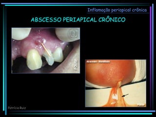 ABSCESSO PERIAPICAL CRÔNICO
Inflamação periapical crônica
Patrícia Ruiz
 