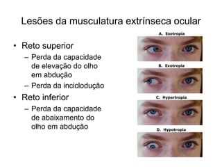 Lesões da musculatura extrínseca ocular 
• Reto superior 
– Perda da capacidade 
de elevação do olho 
em abdução 
– Perda da inciclodução 
• Reto inferior 
– Perda da capacidade 
de abaixamento do 
olho em abdução 
 