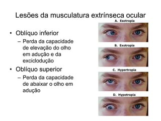 Lesões da musculatura extrínseca ocular 
• Oblíquo inferior 
– Perda da capacidade 
de elevação do olho 
em adução e da 
exciclodução 
• Oblíquo superior 
– Perda da capacidade 
de abaixar o olho em 
adução 
 