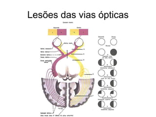 Lesões das vias ópticas 
 