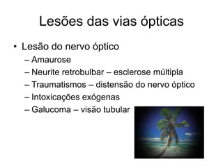 Lesões das vias ópticas 
• Lesão do nervo óptico 
– Amaurose 
– Neurite retrobulbar – esclerose múltipla 
– Traumatismos – distensão do nervo óptico 
– Intoxicações exógenas 
– Galucoma – visão tubular 
 