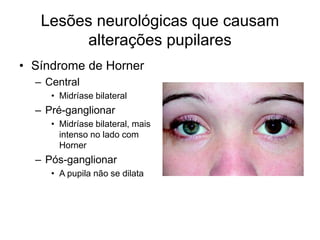 Alteração visual e sintomas correlatos | PPT