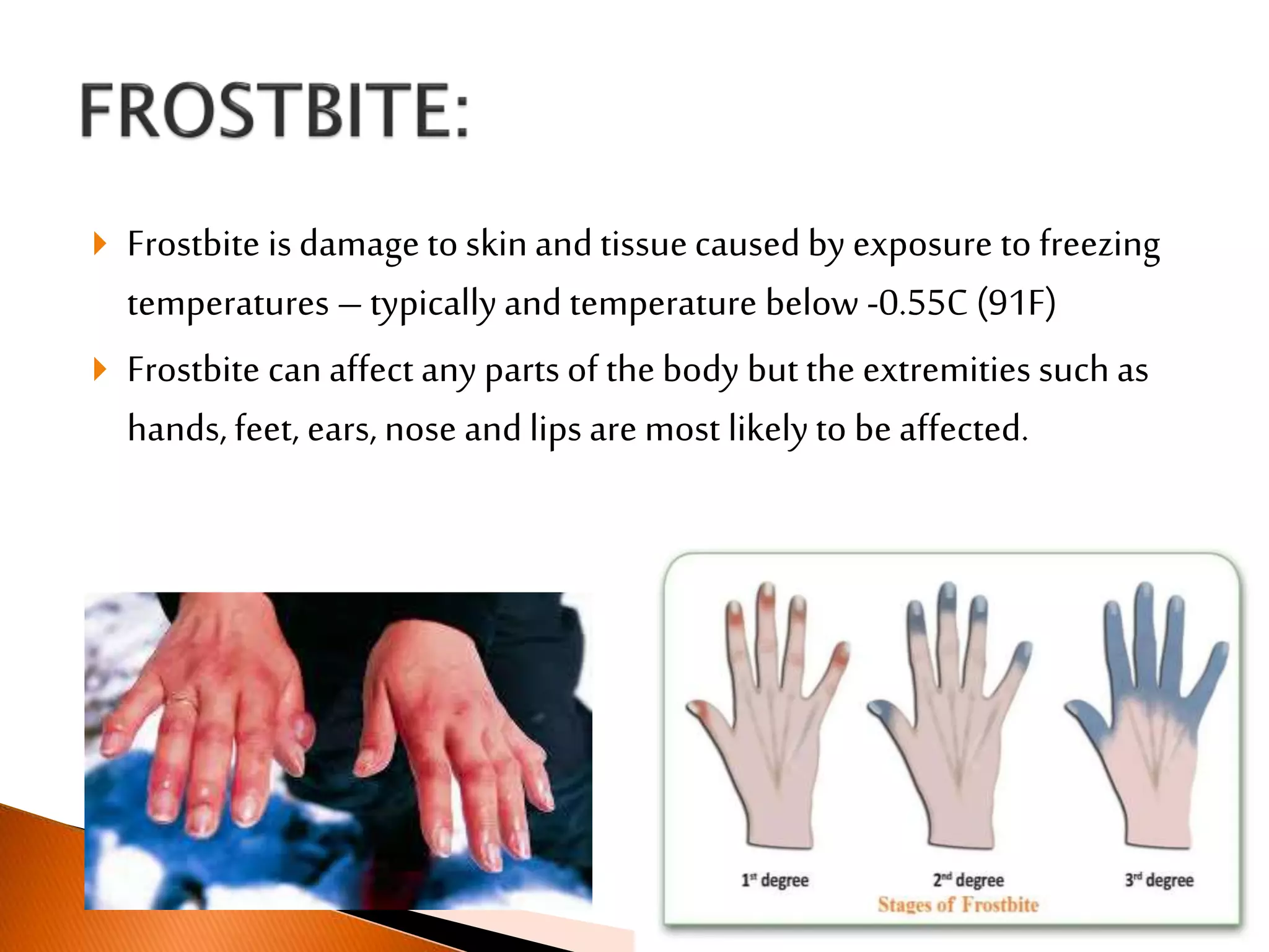  Frostbite is damage to skinand tissuecaused by exposure to freezing
temperatures – typicallyand temperature below -0.55C (91F)
 Frostbite can affect any parts of the body but the extremities such as
hands, feet, ears, nose and lips are most likelyto be affected.
 
